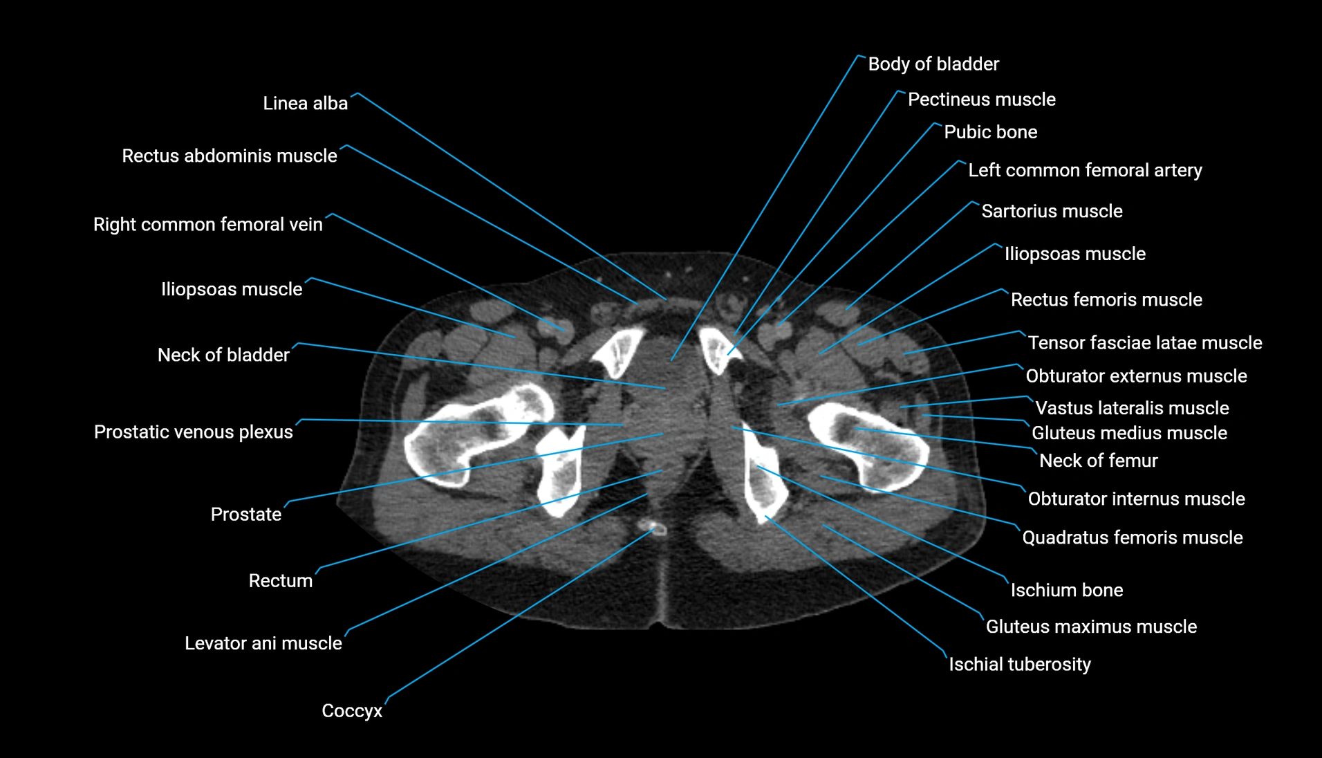 CT urogram axial cross sectional anatomy  labelled radiology image-00247.webp